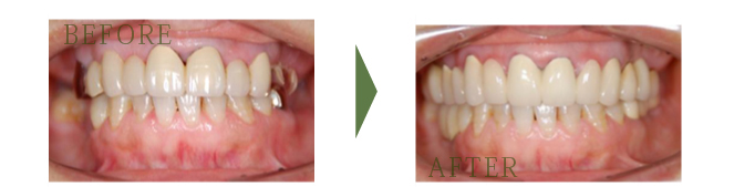 インプラント治療例4