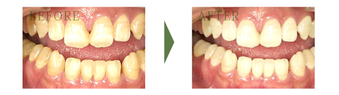 審美歯科治療例の図