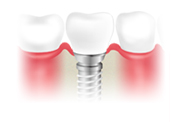 インプラント